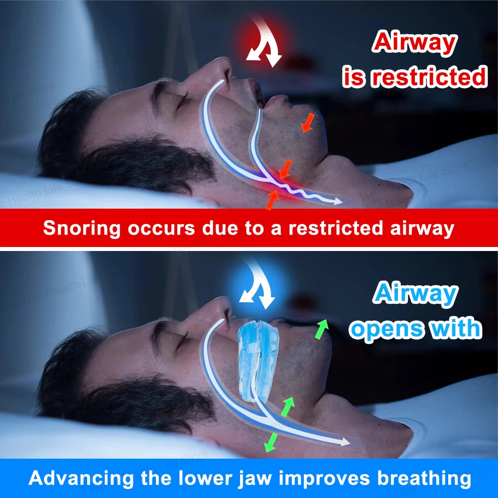 Adjustable Anti-Snoring Mouth Guard | Stop Snoring & Relieve Bruxism